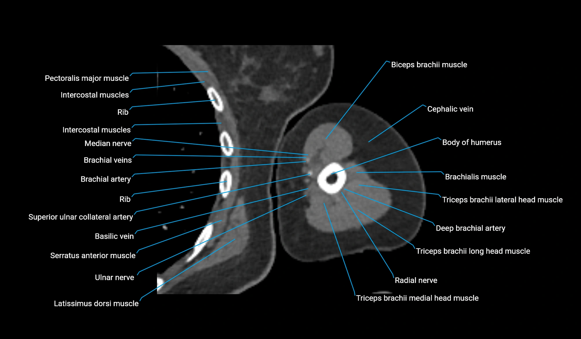 CT upper arm axial  cross sectional anatomy labelled radiology image -00240.webp
